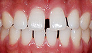 앞니 사이가 벌어져 있는 경우 before