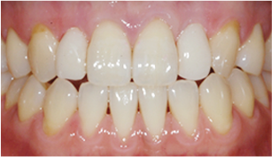 앞니의 치아크기가 서로 다른 경우 after