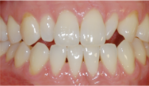 앞니의 치아크기가 서로 다른 경우 before