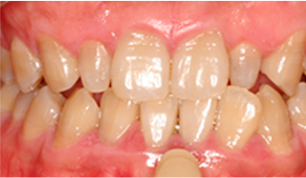 앞니치아가 변색 된 경우 before