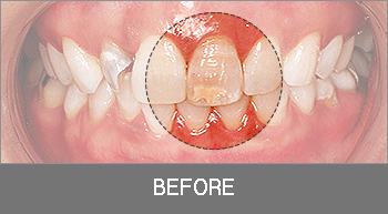 라미네이트 before