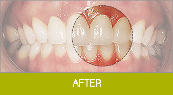 라미네이트 after