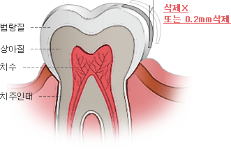 라미네이트 시술이 필요한 경우