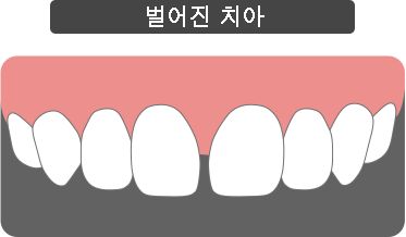 라미네이트 시술이 필요한 경우