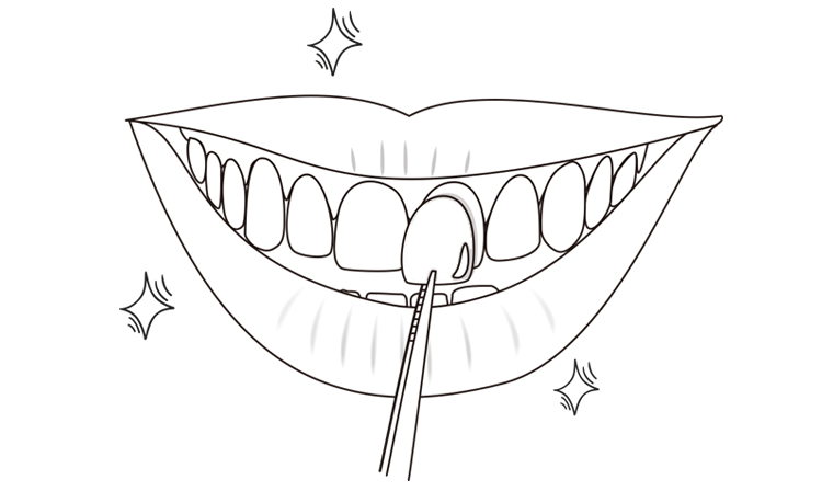 라미네이트 제작완료 및 부착