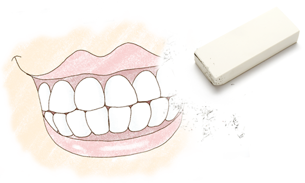 라미네이트의 가장 중요한 성공조건의 치아삭제량!