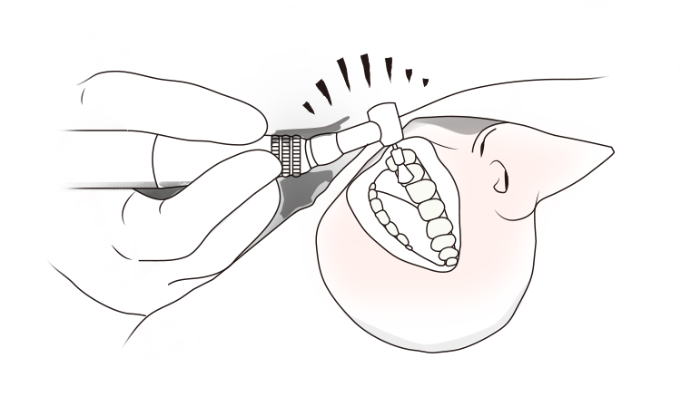 치아 표면 정리