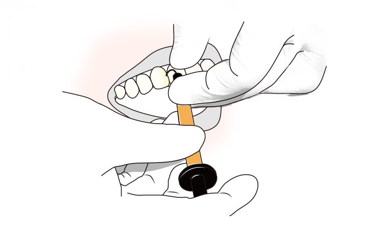 필요한 부위에 레진 채우기