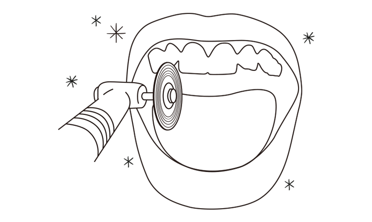 0.3~0.5mm 치아삭제