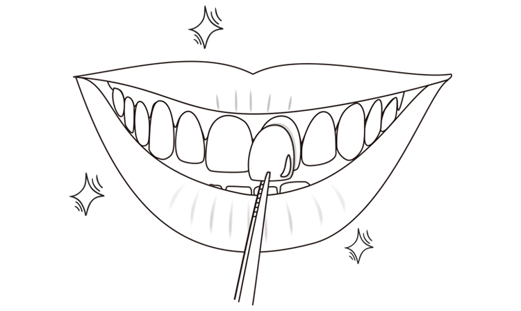 라미네이트 제작 및 부착