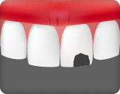 앞니 사이에 충치가 생깅 경우