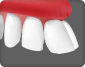 앞니가 앞으로 돌축되어 있는 경우