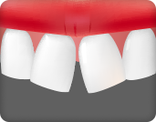 앞니가 삐뚤빼뚤한 경우