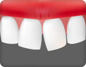 삐뚤삐뚤한 치아를 빠르게 교정하고 싶은 경우