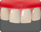 치아미백으로 개선이 되지 않는 누렇게거나 검은 치아의 개선을 원할 경우