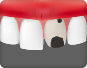 앞니 충치가 심해 신경 치료가 필요한 경우