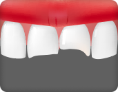 앞니가 부러져 신경치료가 필요한 경우
