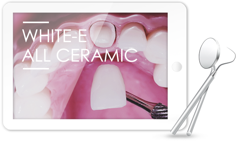 올세라믹 이런 분들에게 필요해요!