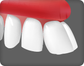 돌출치아를 빠르게 교정하고 싶은 경우