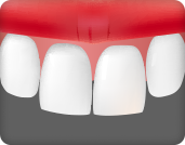 심한 덧니를 빠르게 교정하고 싶은 경우