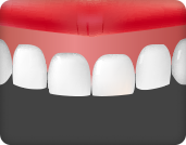 잇몸이 치아를 많이 덮는 경우