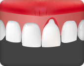 잇몸 질환으로 인해 잇몸이 유실된 경우