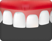 잇몸 스마일 라인이 비대칭인 경우