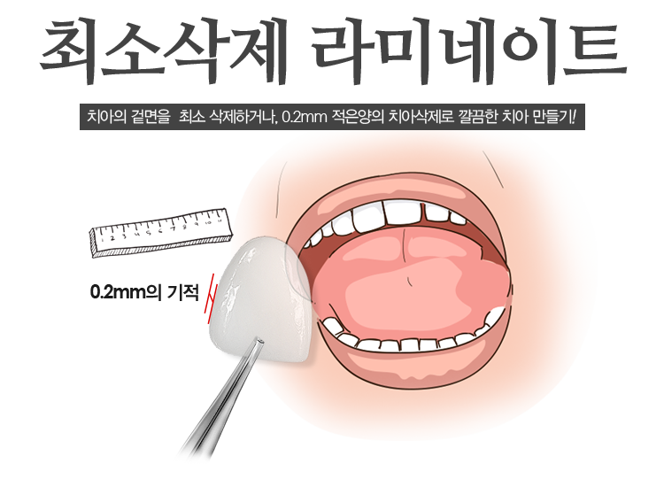 최소삭제 라미네이트