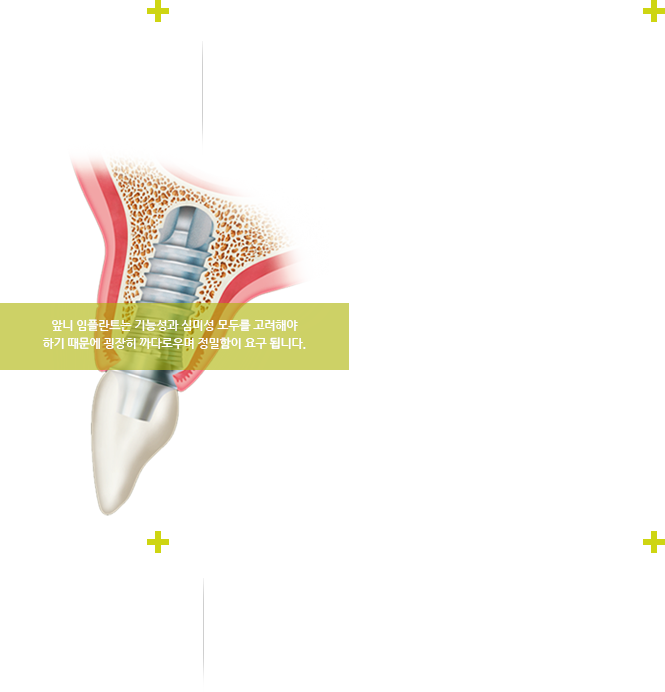 앞니 임플란트는 기능성과 심미성 모두를 고려해야 하기 대문에 굉장히 까다로우며 정밀함이 요구됩니다.