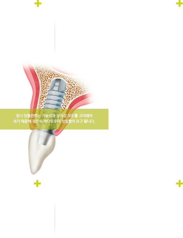 앞니 임플란트는 기능성과 심미성 모두를 고려해야 하기 대문에 굉장히 까다로우며 정밀함이 요구됩니다.