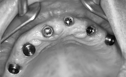 화이트E 전악 임플란트