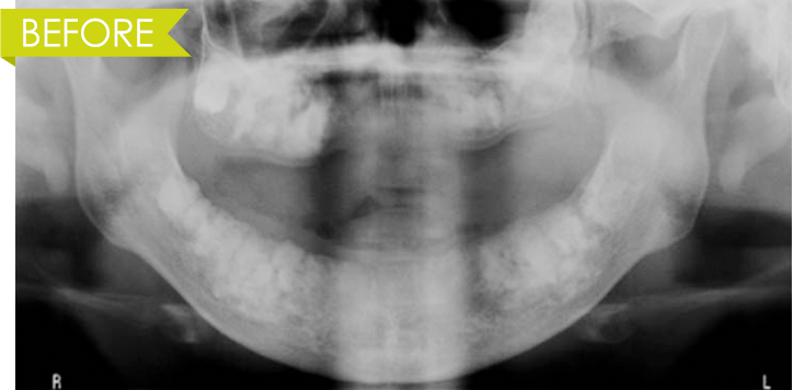 전악(무치악) 임플란트 before