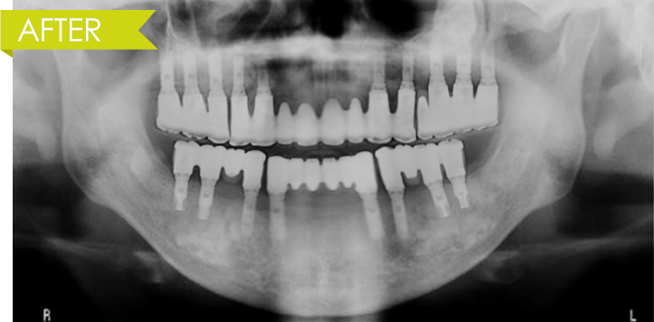 전악(무치악) 임플란트 after