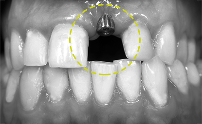 화이트E 앞니 임플란트