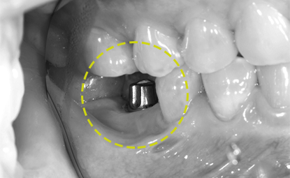 어금니 임플란트