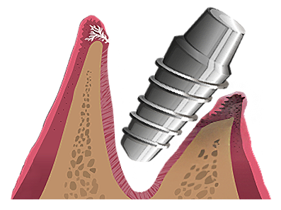 어금니 임플란트