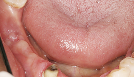 임플란트 뼈이식 before