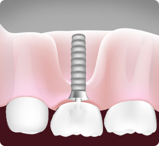 임플란트 뼈이식 after