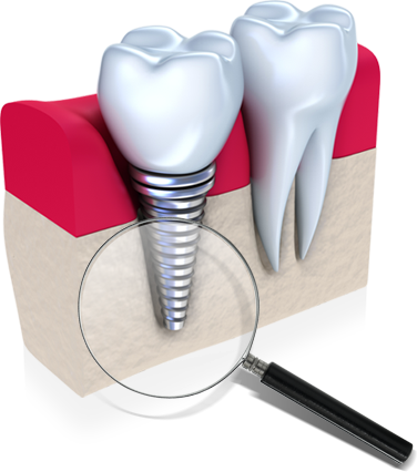 임플란트 뼈이식 수술 후 관리