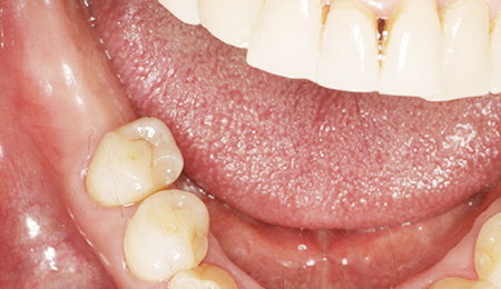 임플란트 뼈이식 after