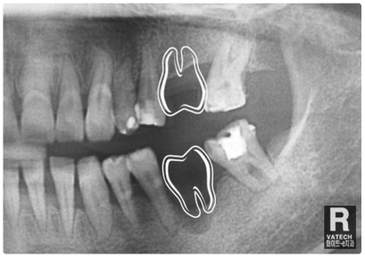 임플란트 식립(2차수술)