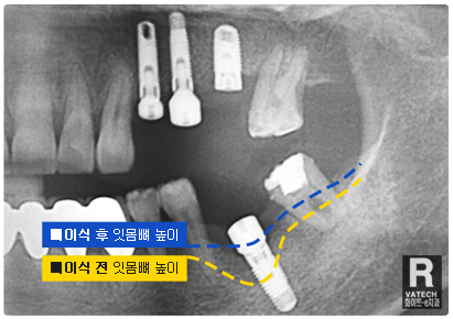 임플란트 식립(2차수술)