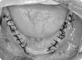 뼈이식 진행(1차수술)