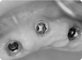 임플란트 식립(2차수술)