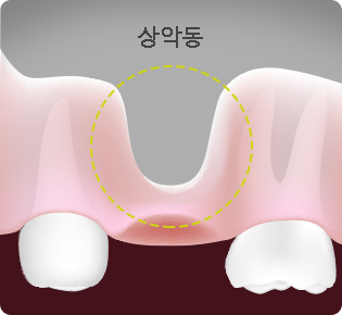 임플란트 뼈이식 before