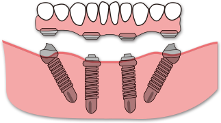 임플란트 보철 제작