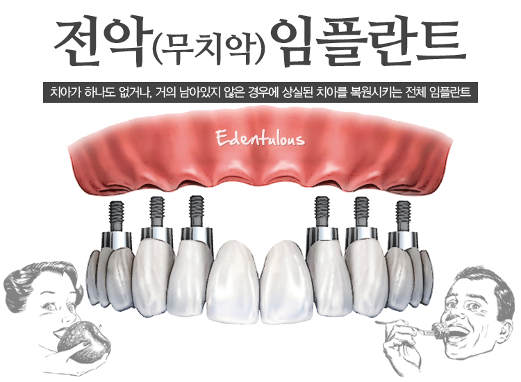 전악 임플란트