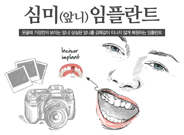 앞니 임플란트