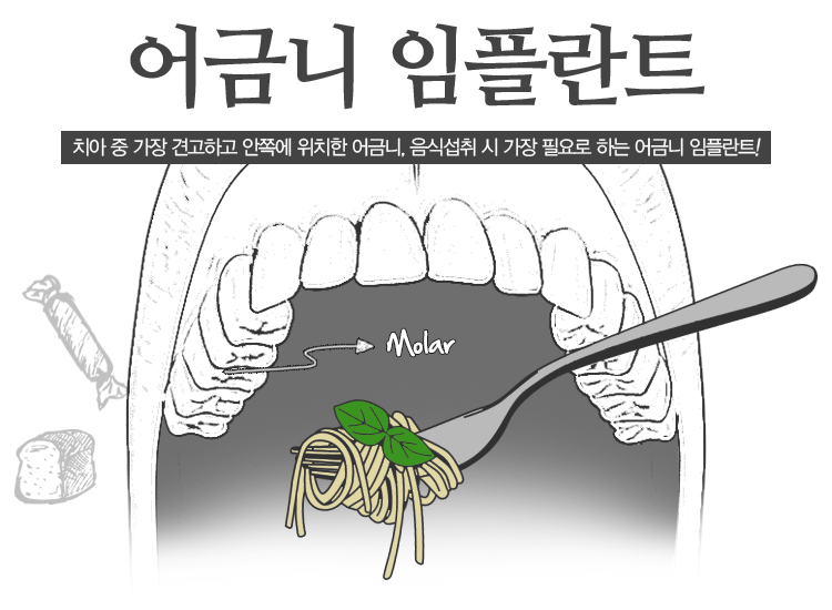 어금니 임플란트