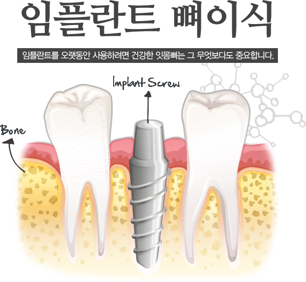 임플란트 뼈이식